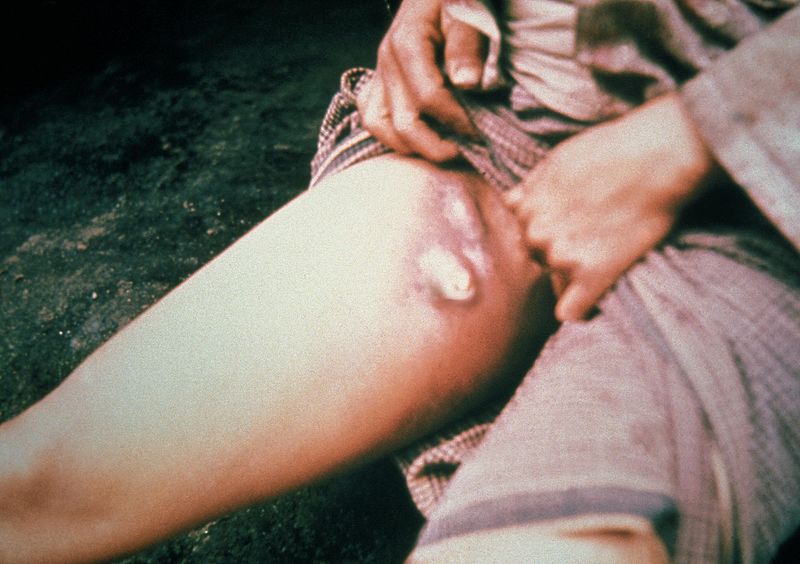 The upper thigh of a person infected with bubonic plague. It shows the buboes