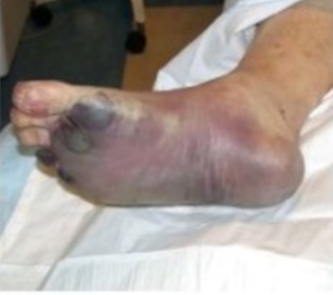 Swelling and necrosis caused on the feet of a person infected with septicemic plague